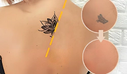 Imagen principal del artículo 'Las mejores soluciones para corrección de tatuajes y cicatrices'