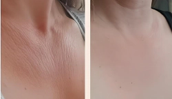 Imagen principal del artículo 'Las mejores soluciones para rejuvenecer cuello y escote'